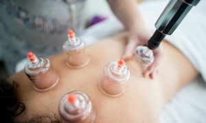 Revitalise your body and mind: The benefits of cupping therapy