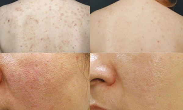 How taking on a treatment like PlaDuo can elevate your beauty menu without invasive treatments